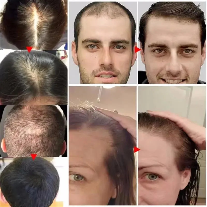 Fast Hair Growth Serum Hair Regrowth Essential Oil Anti Hair Loss Repair Damaged Scalp Women Men Anti Baldness Hair Growth Care