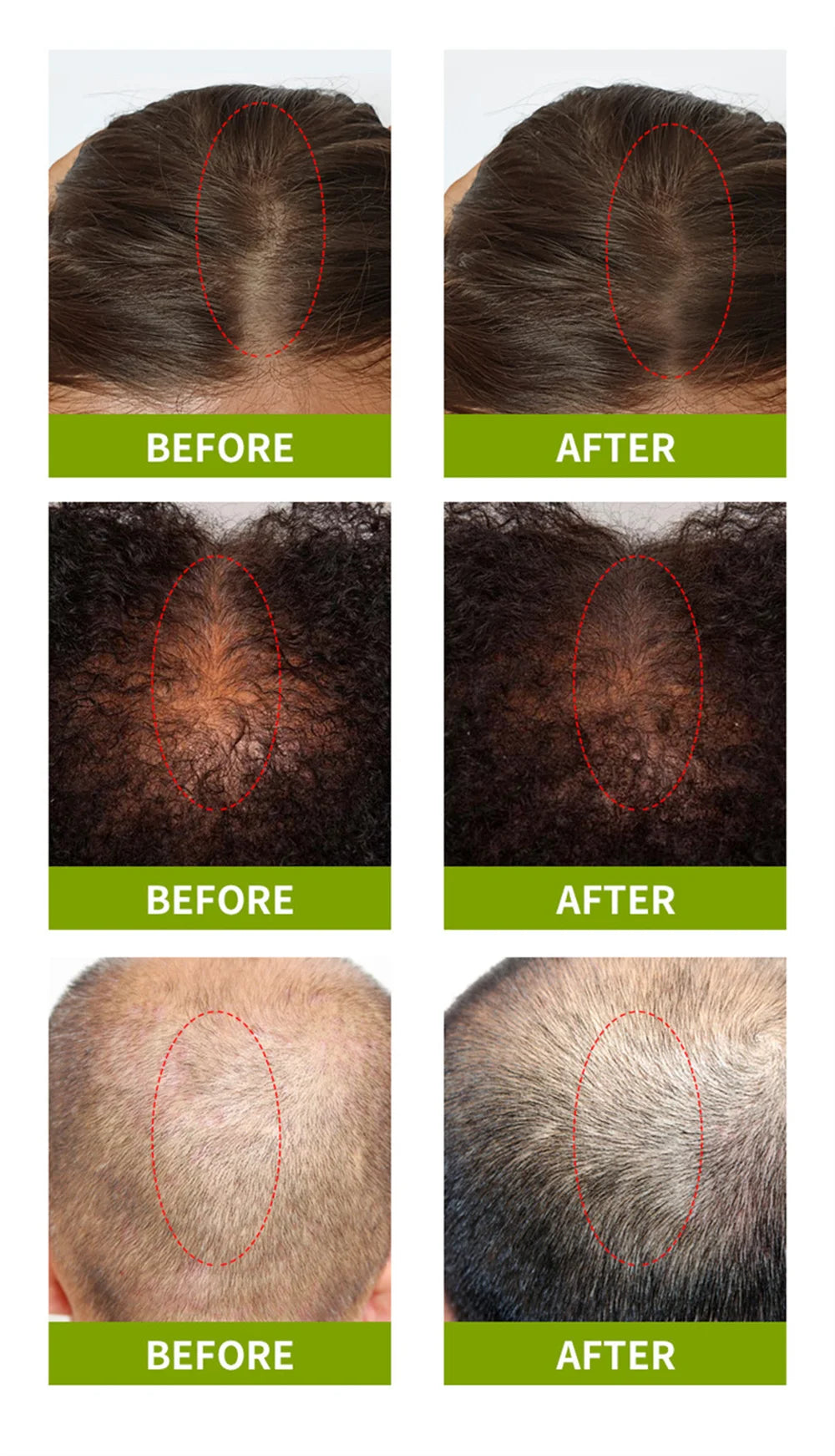 Fast Hair Growth Serum Hair Regrowth Essential Oil Anti Hair Loss Repair Damaged Scalp Women Men Anti Baldness Hair Growth Care