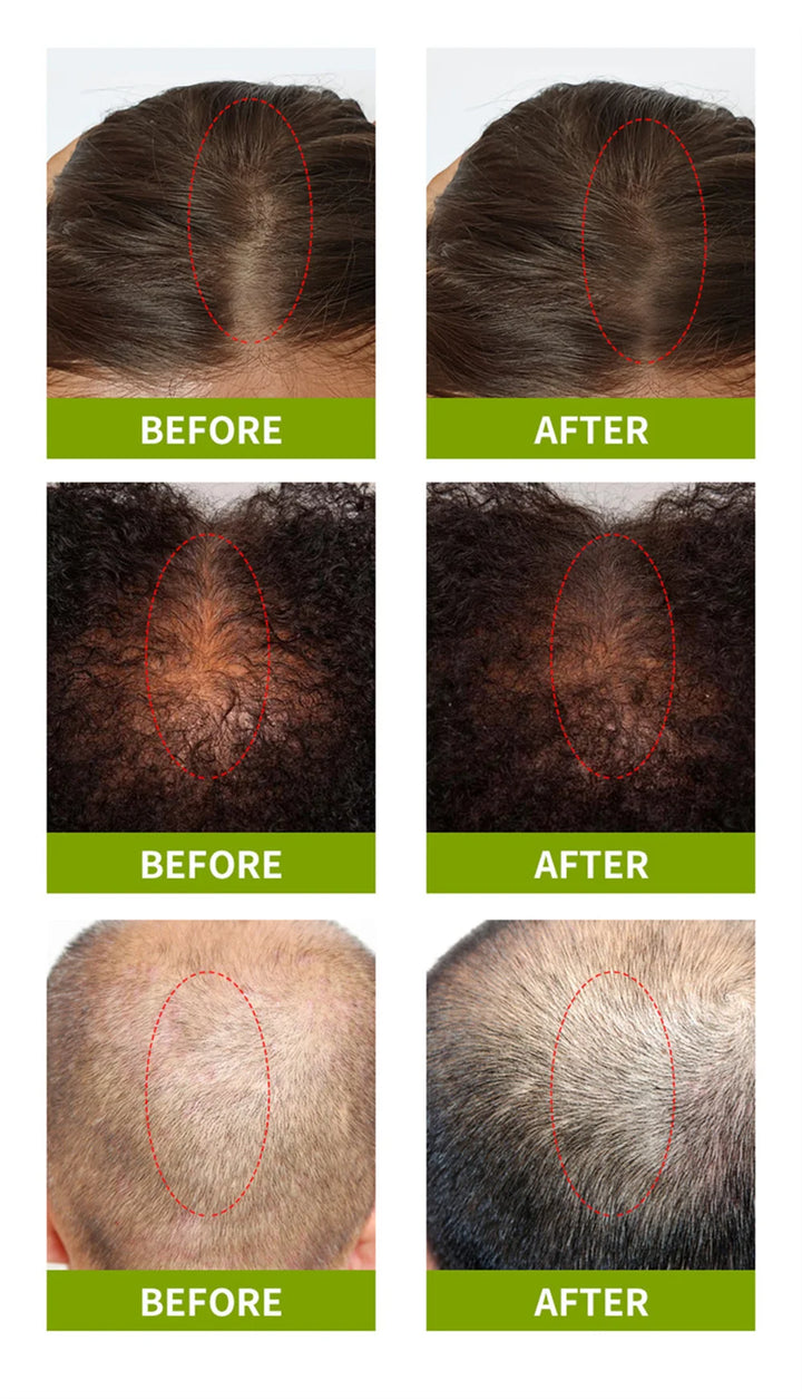 Fast Hair Growth Serum Hair Regrowth Essential Oil Anti Hair Loss Repair Damaged Scalp Women Men Anti Baldness Hair Growth Care